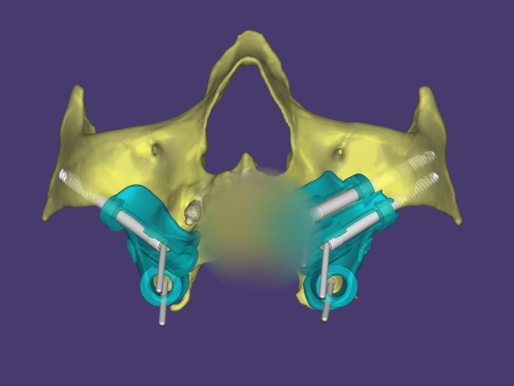 Planejamento digital em 3D